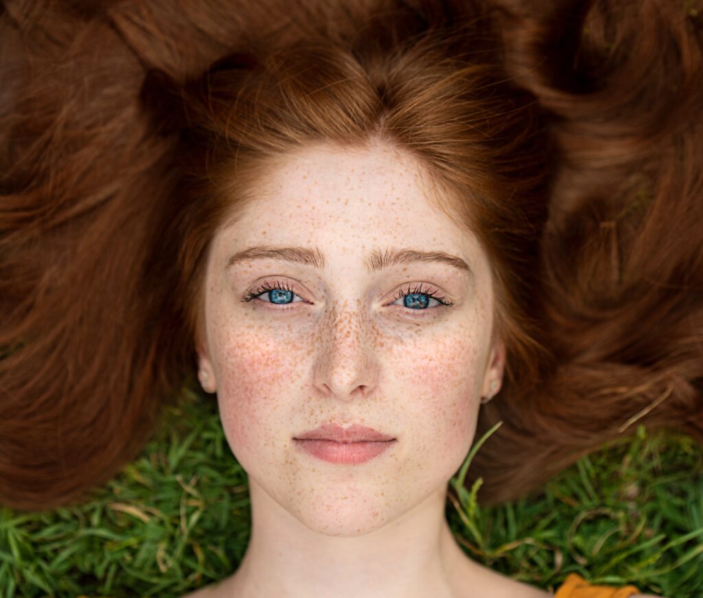 Freckles